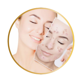 Ação Anti-Acne